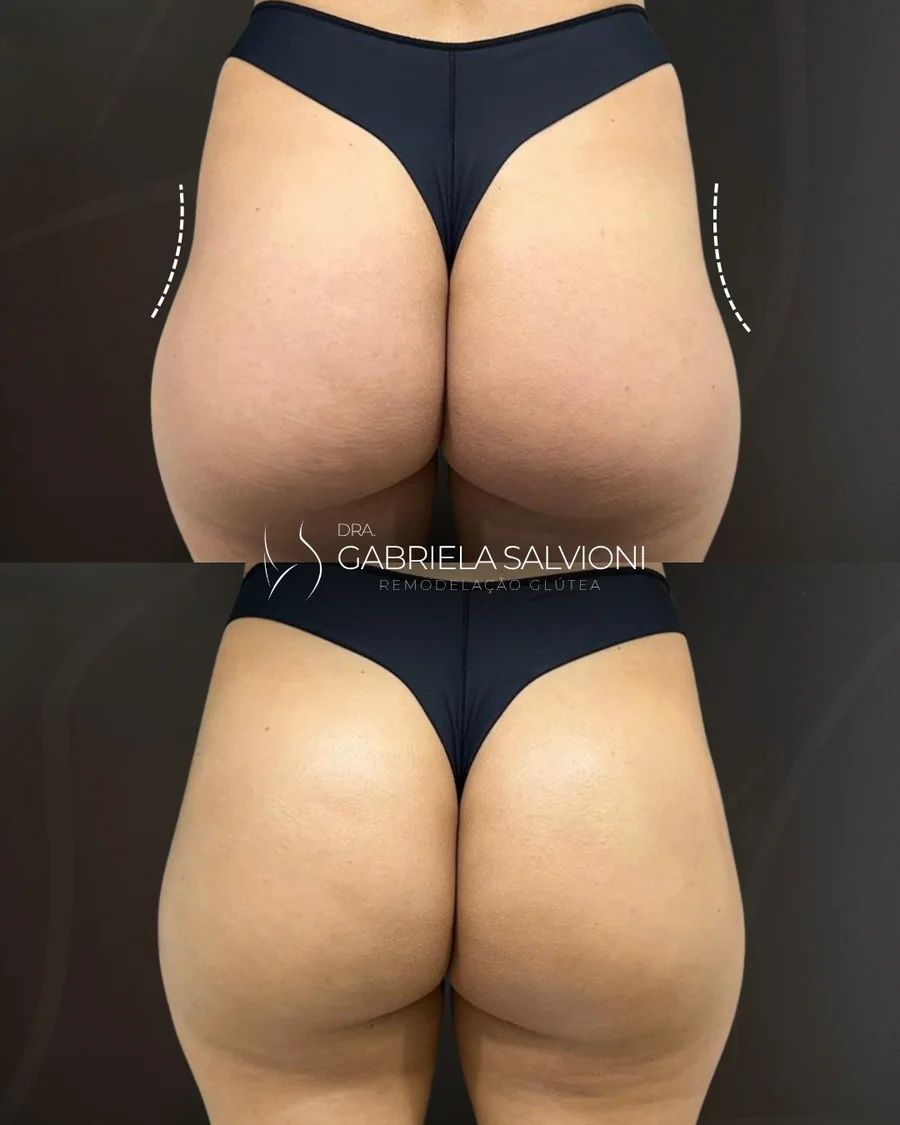 Antes e depois de remodelação glútea, vista posterior