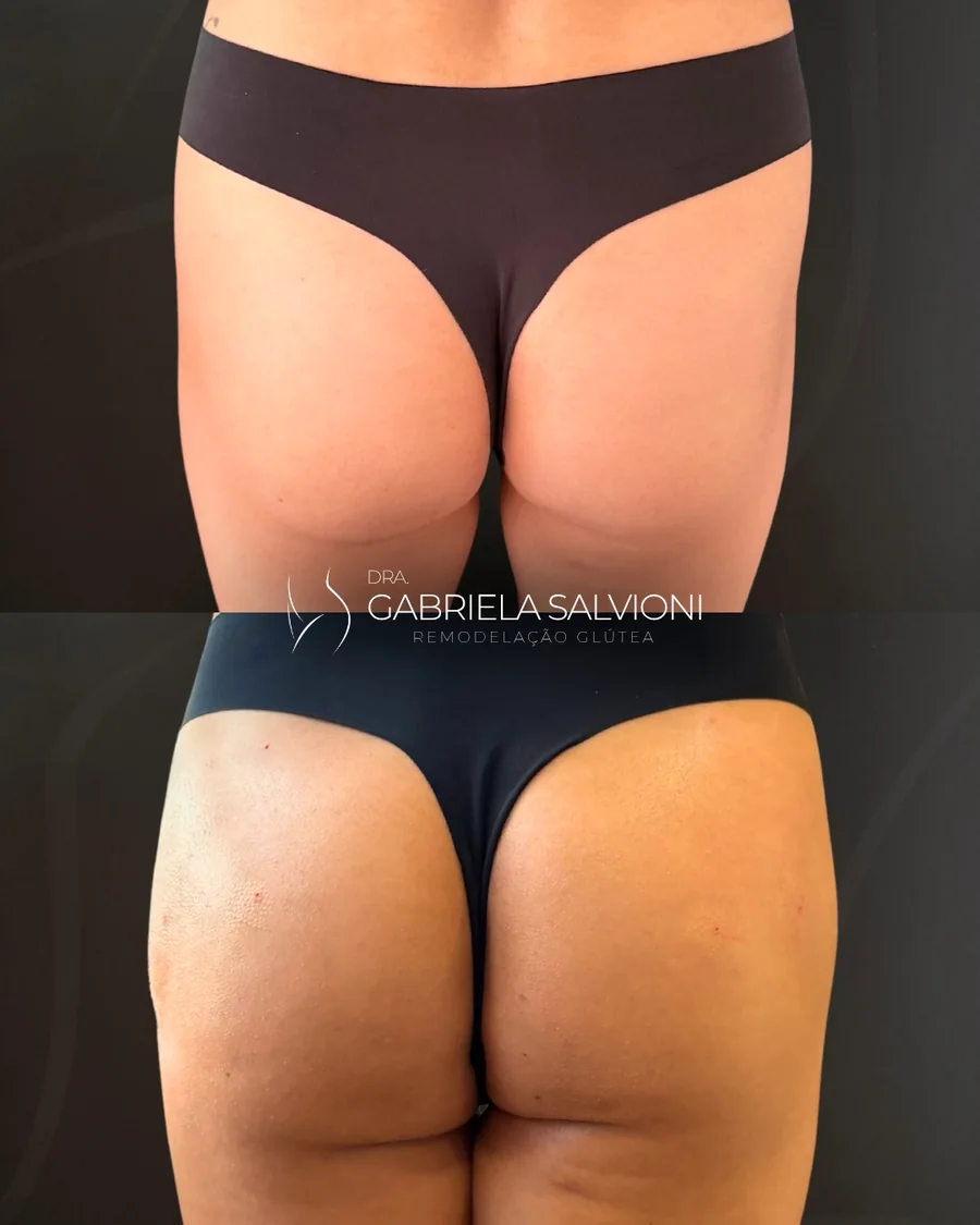 Antes e depois de remodelação glútea com ganho de projeção