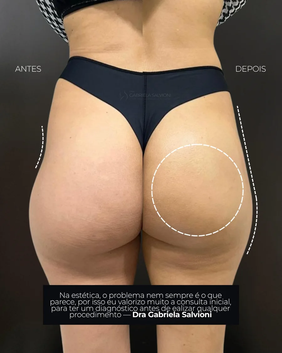 Antes e depois de harmonização glútea com preenchimento da depressão lateral